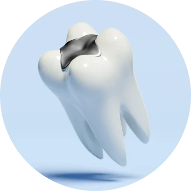 What Are Dental Fillings