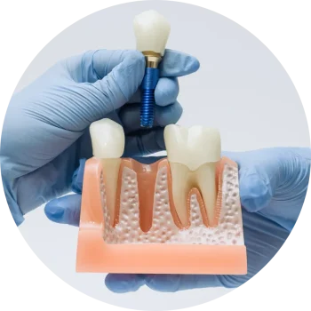 What Are Dental Implants