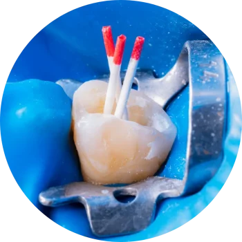 What Is Root Canal Therapy